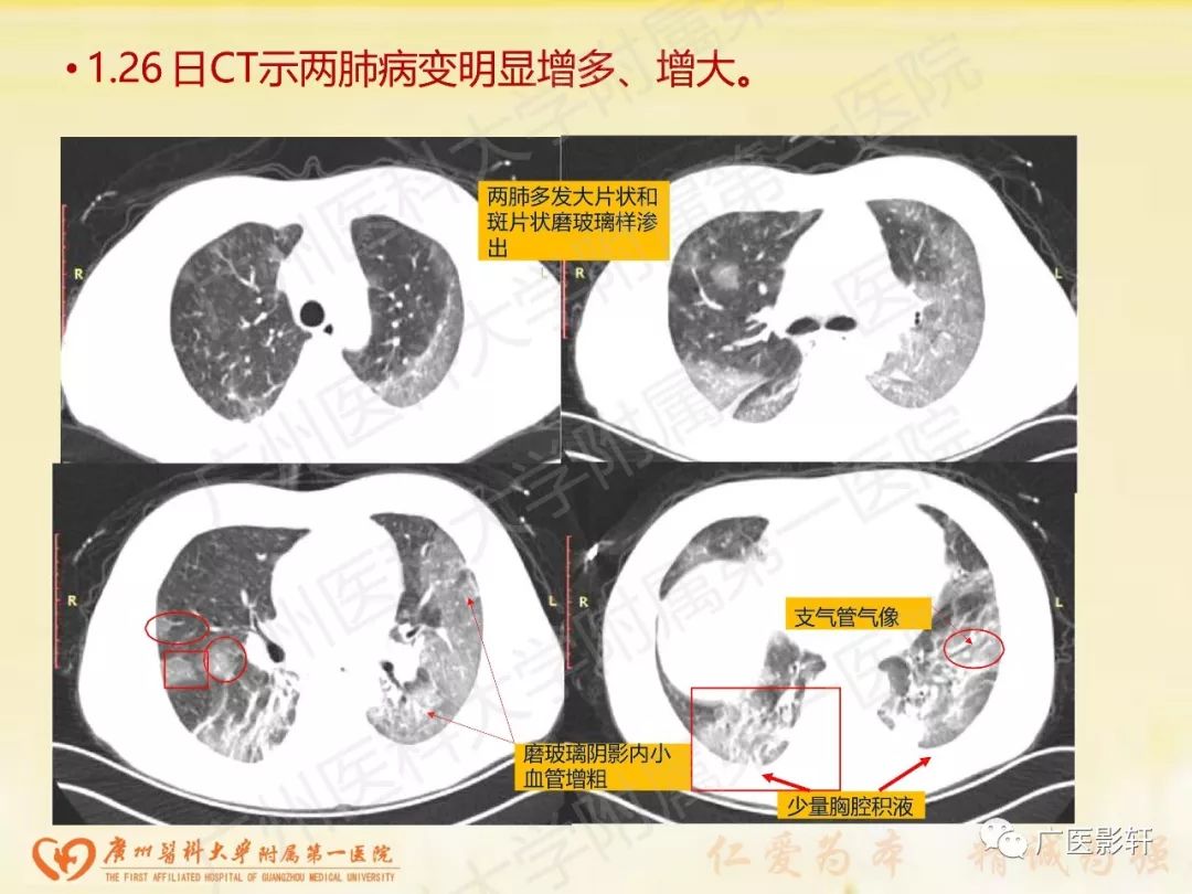 【PPT】新型冠状病毒肺炎影像学特点