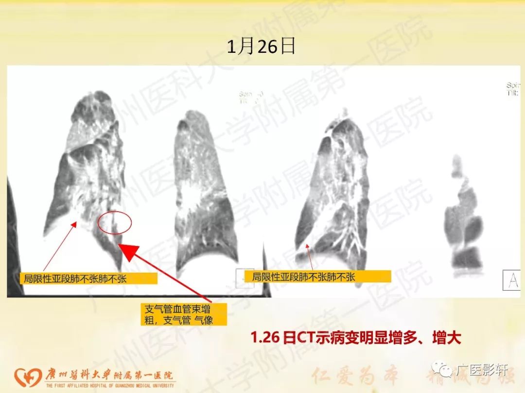 【PPT】新型冠状病毒肺炎影像学特点