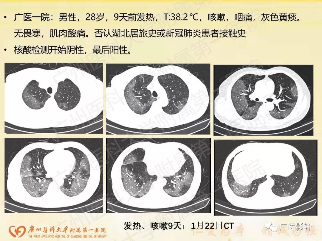 【PPT】新型冠状病毒肺炎影像学特点