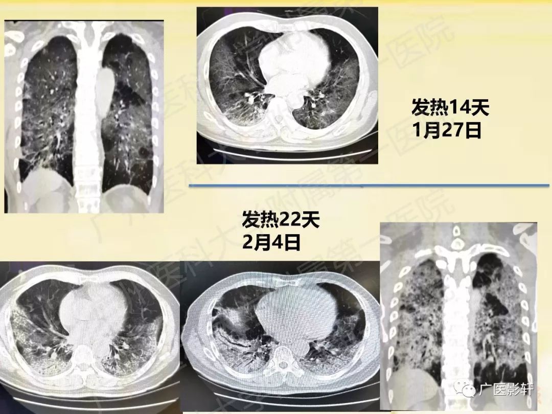 【PPT】新型冠状病毒肺炎影像学特点