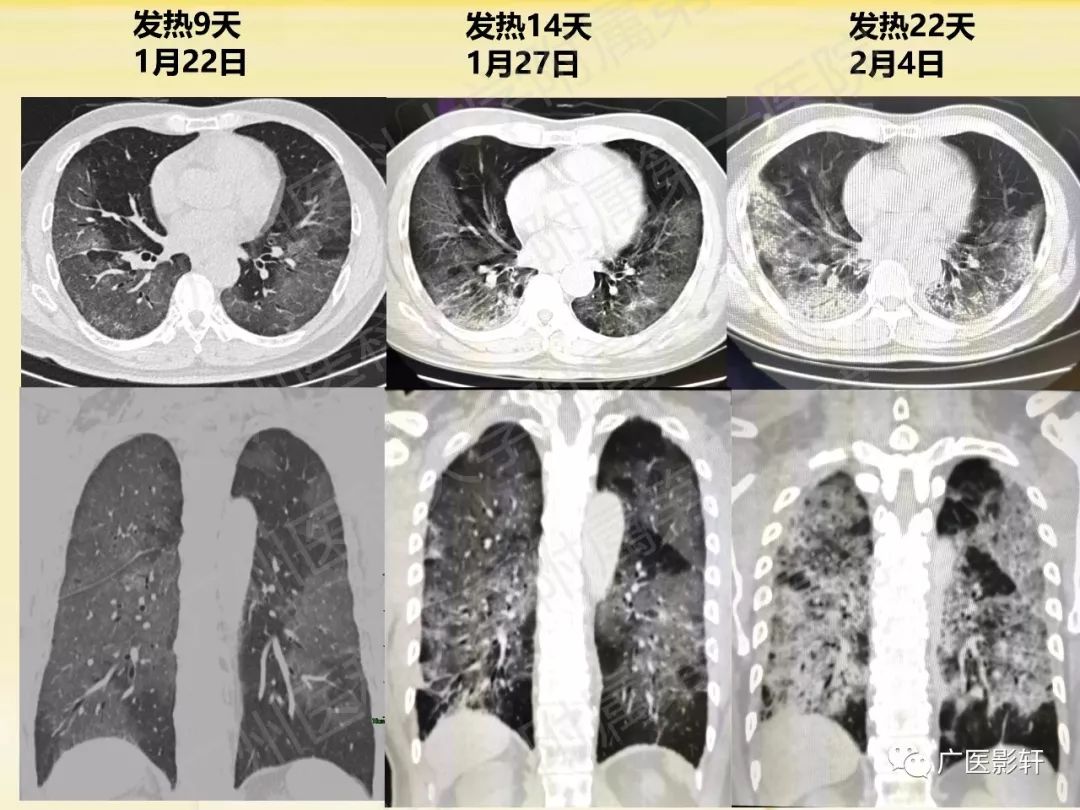【PPT】新型冠状病毒肺炎影像学特点