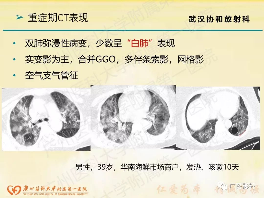 【PPT】新型冠状病毒肺炎影像学特点