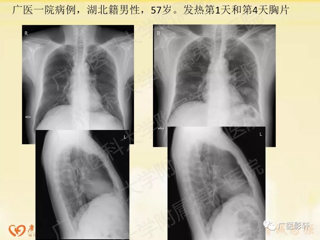 【PPT】新型冠状病毒肺炎影像学特点
