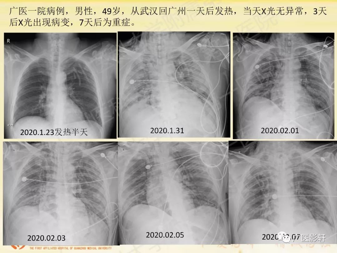 【PPT】新型冠状病毒肺炎影像学特点