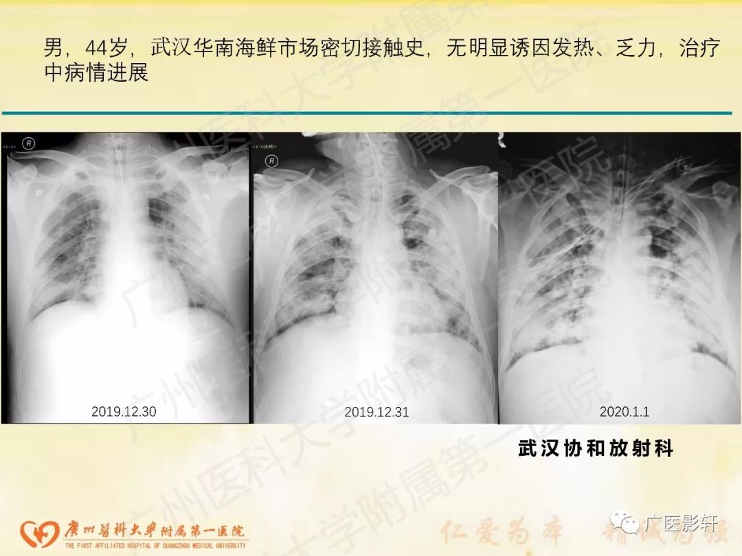 【PPT】新型冠状病毒肺炎影像学特点