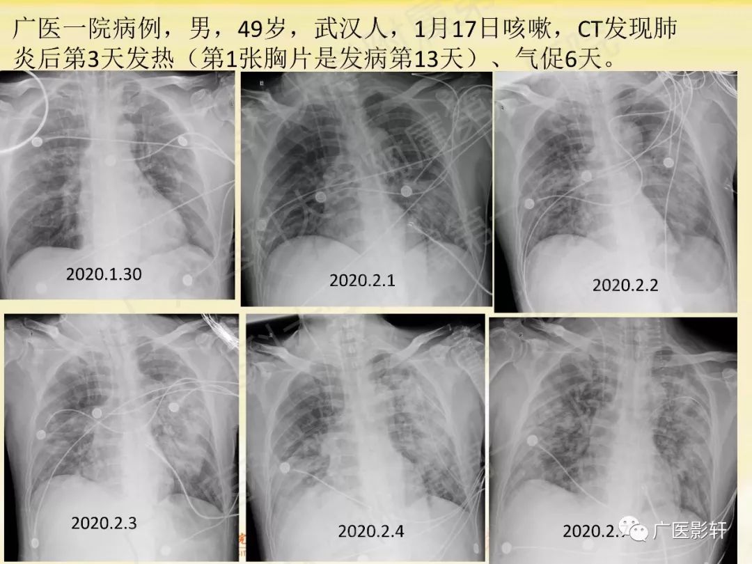 【PPT】新型冠状病毒肺炎影像学特点