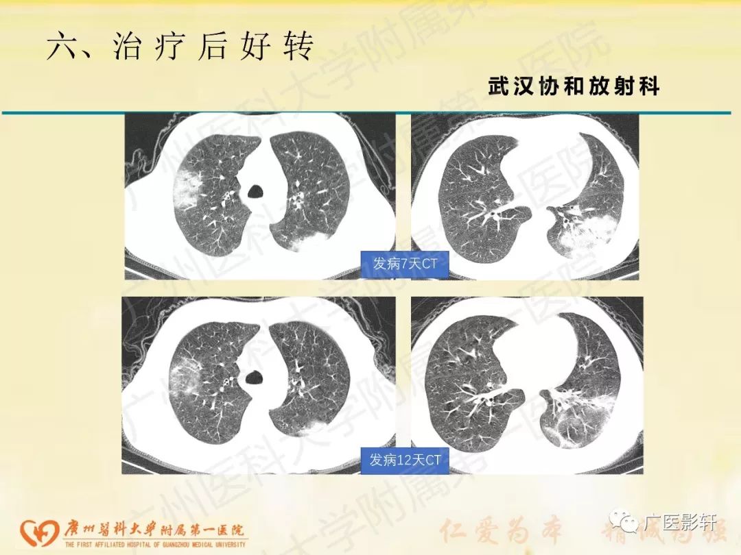 【PPT】新型冠状病毒肺炎影像学特点