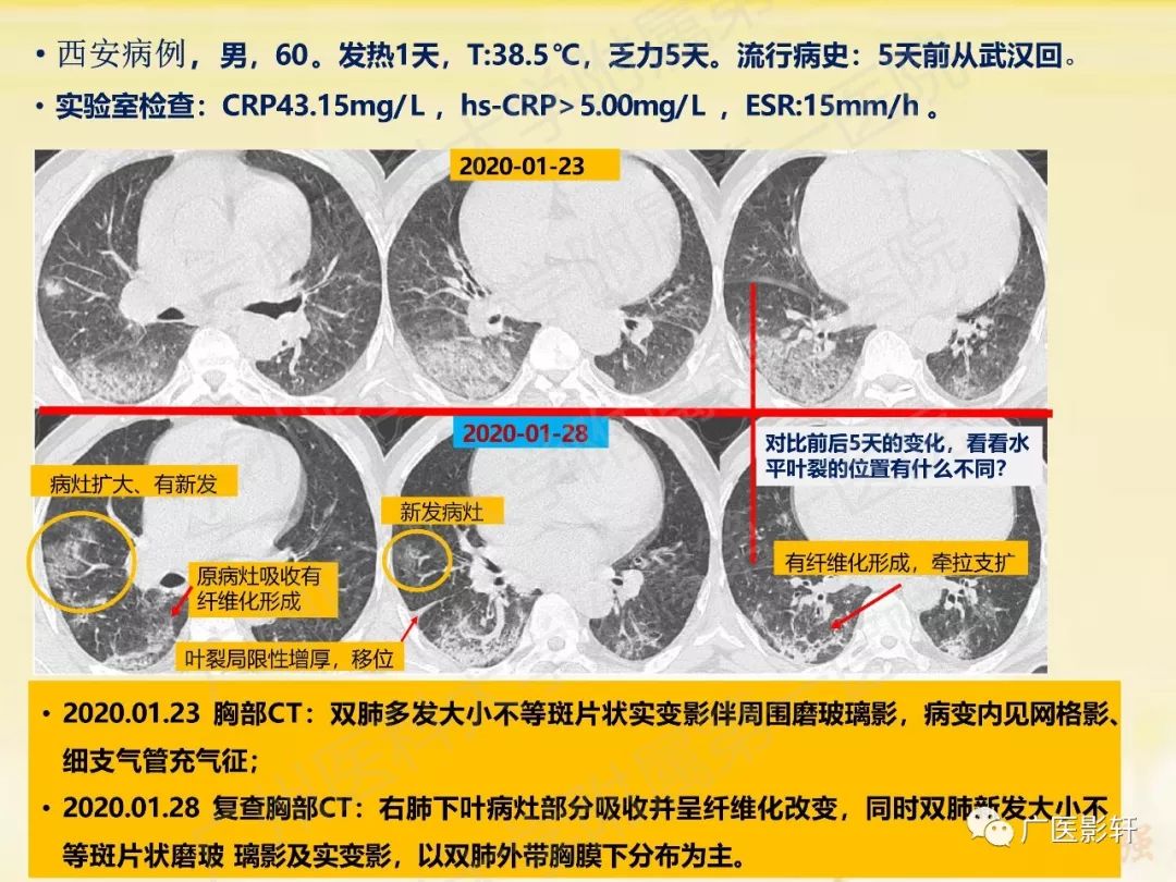 【PPT】新型冠状病毒肺炎影像学特点