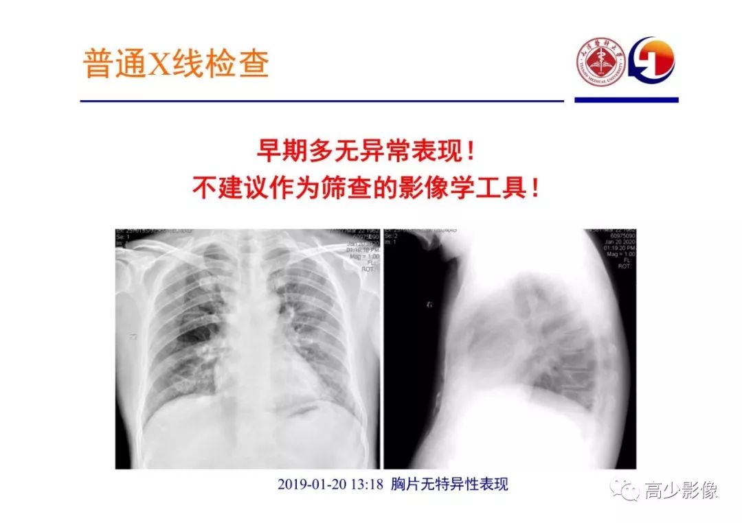 【PPT】新冠状病毒肺炎指南解读及四例影像学表现初步总结