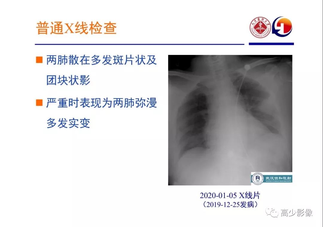 【PPT】新冠状病毒肺炎指南解读及四例影像学表现初步总结