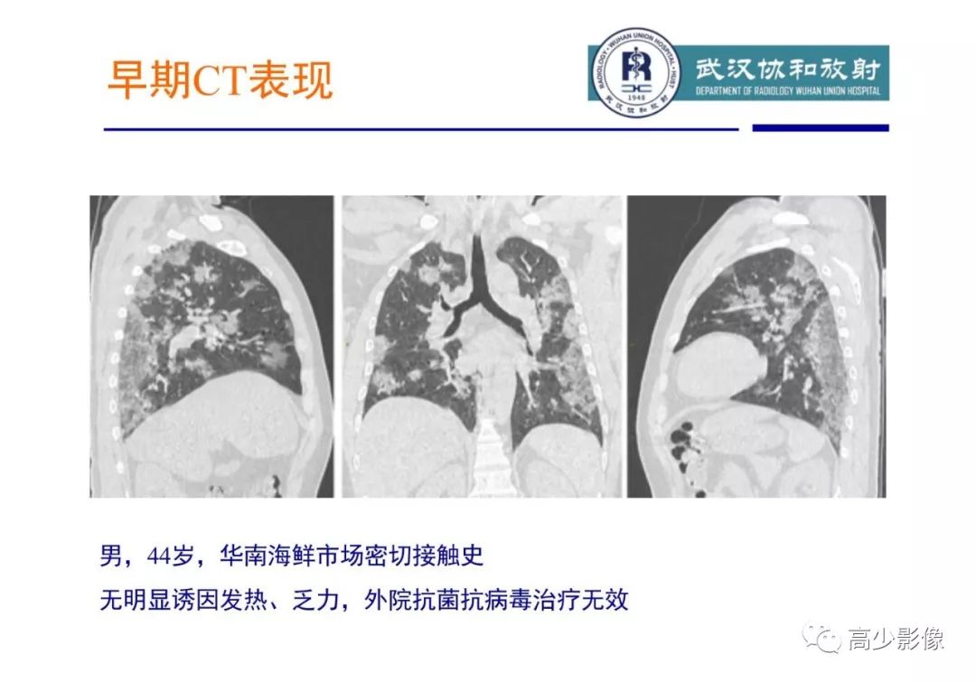 【PPT】新冠状病毒肺炎指南解读及四例影像学表现初步总结