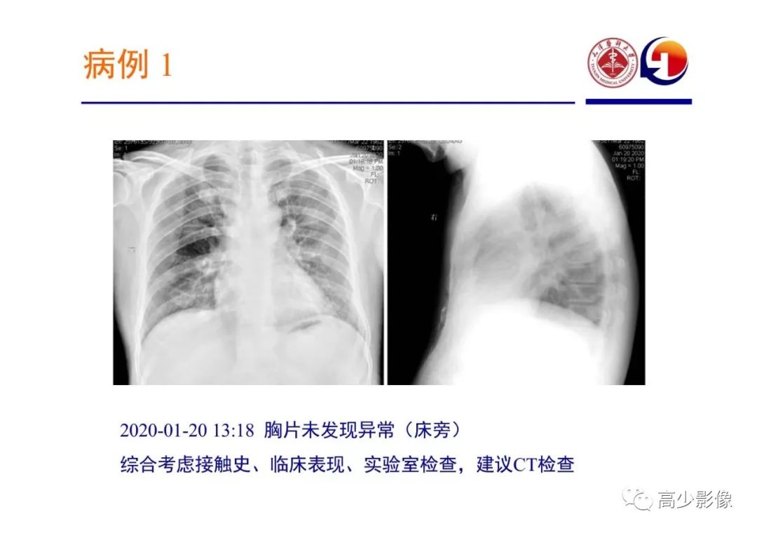【PPT】新冠状病毒肺炎指南解读及四例影像学表现初步总结