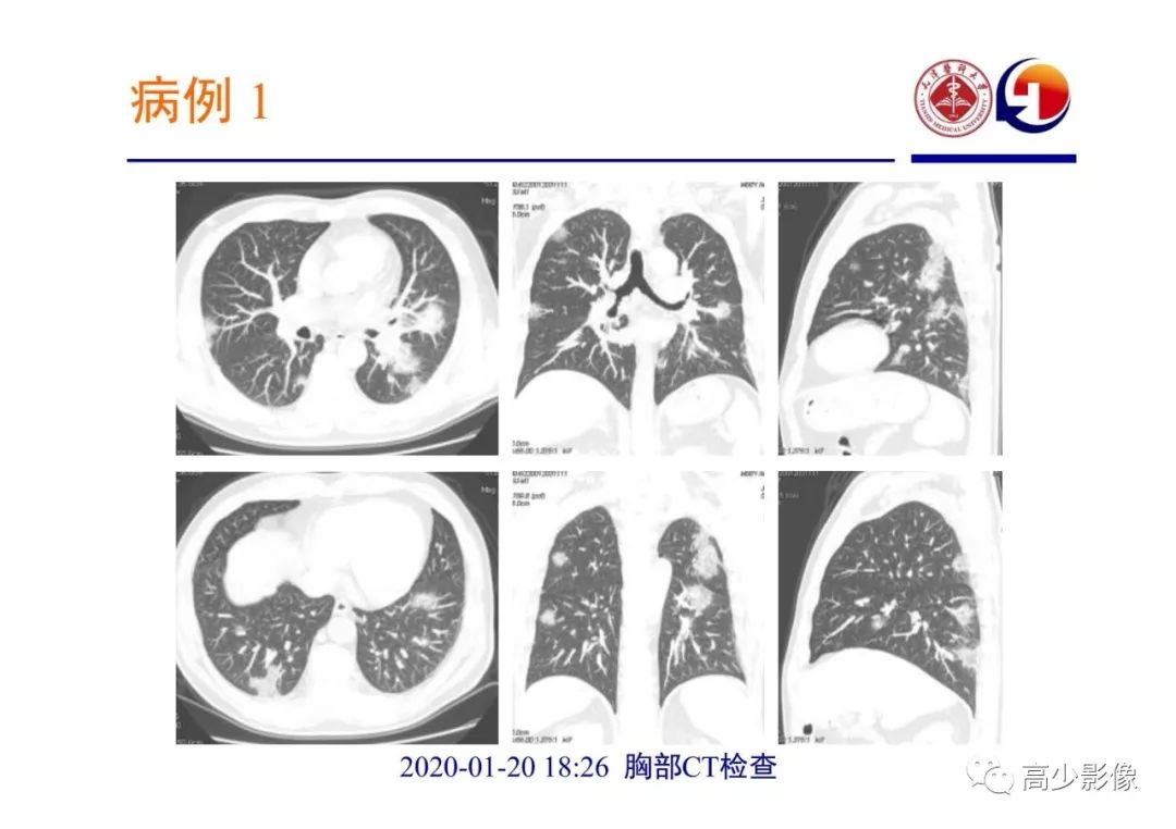 【PPT】新冠状病毒肺炎指南解读及四例影像学表现初步总结