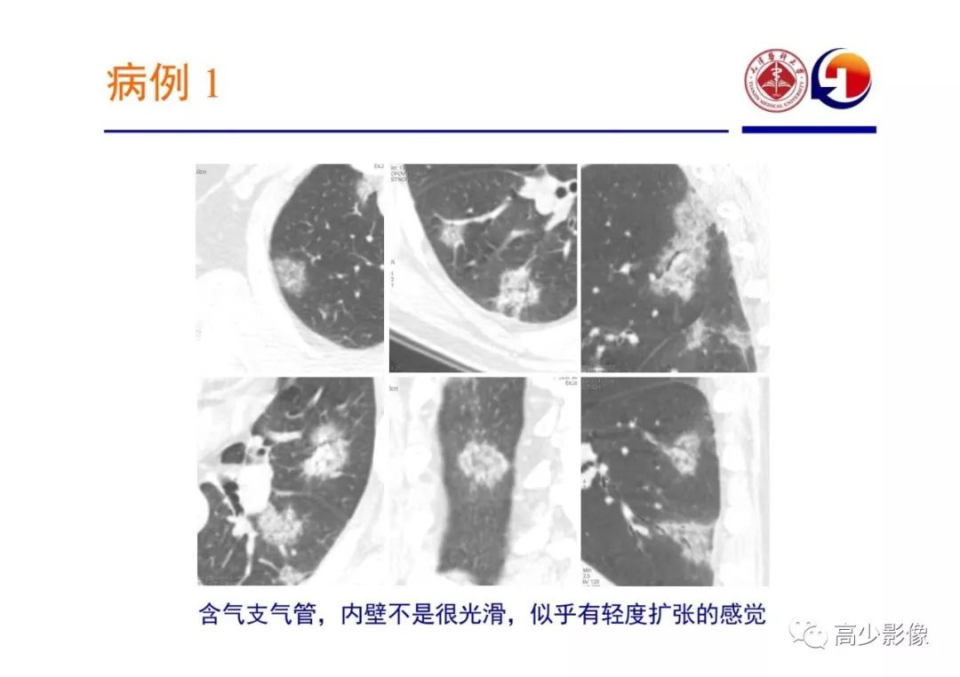 【PPT】新冠状病毒肺炎指南解读及四例影像学表现初步总结