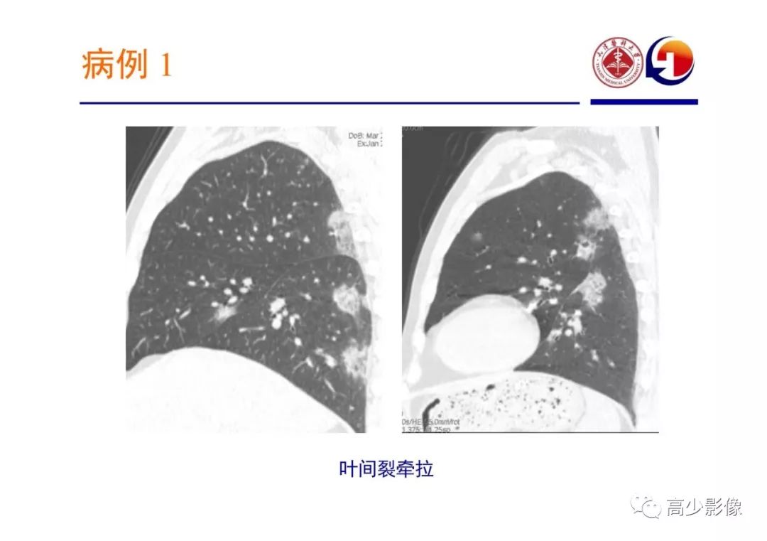 【PPT】新冠状病毒肺炎指南解读及四例影像学表现初步总结