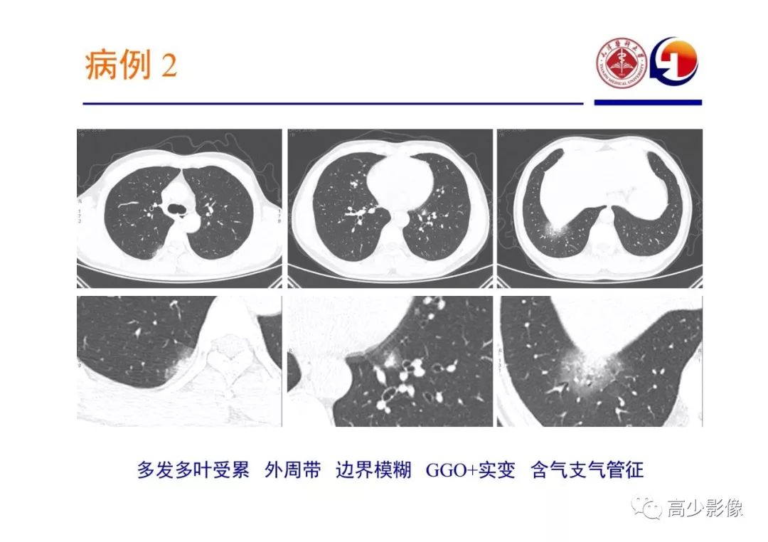 【PPT】新冠状病毒肺炎指南解读及四例影像学表现初步总结