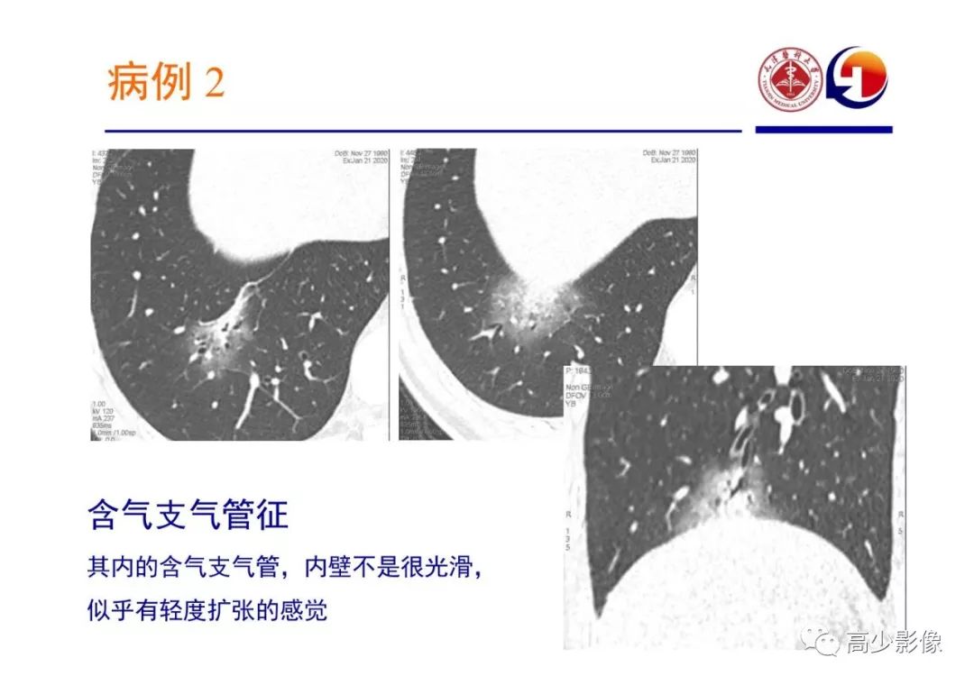 【PPT】新冠状病毒肺炎指南解读及四例影像学表现初步总结