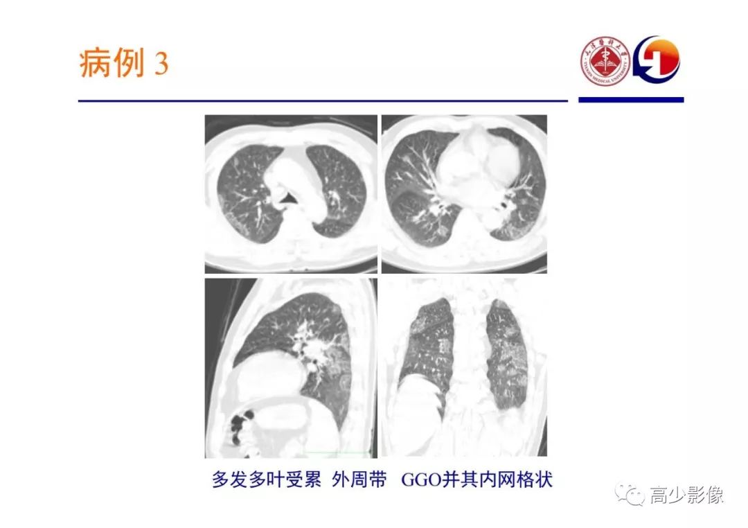 【PPT】新冠状病毒肺炎指南解读及四例影像学表现初步总结