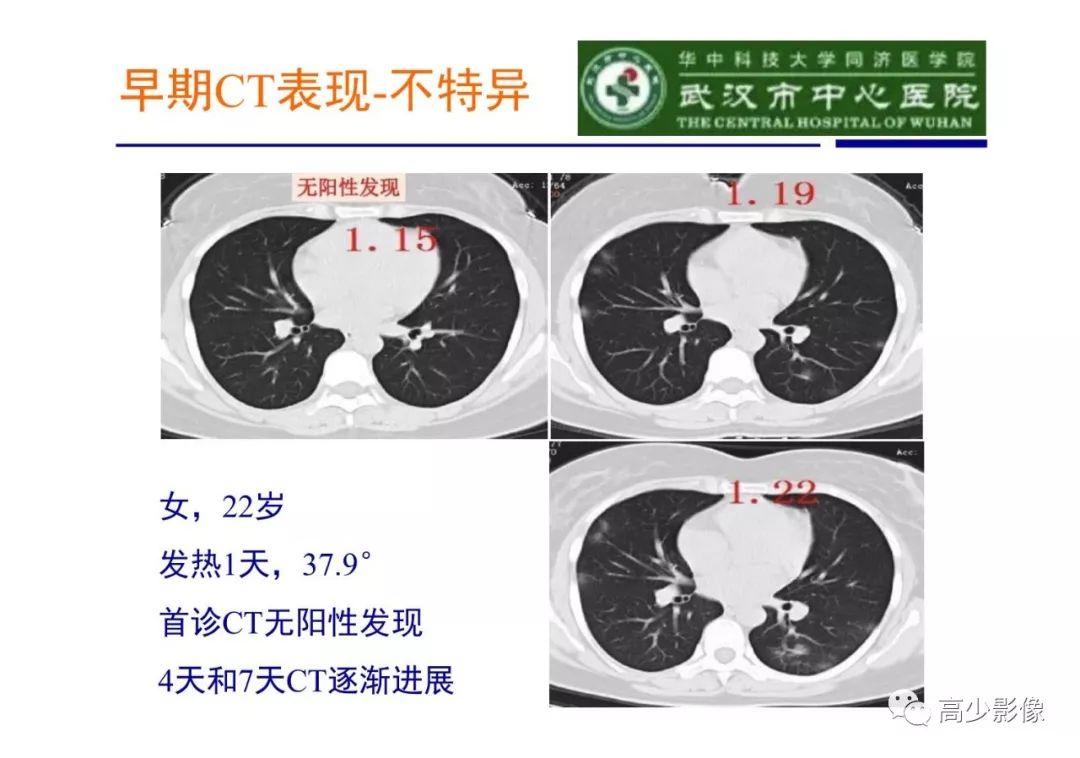 【PPT】新冠状病毒肺炎指南解读及四例影像学表现初步总结
