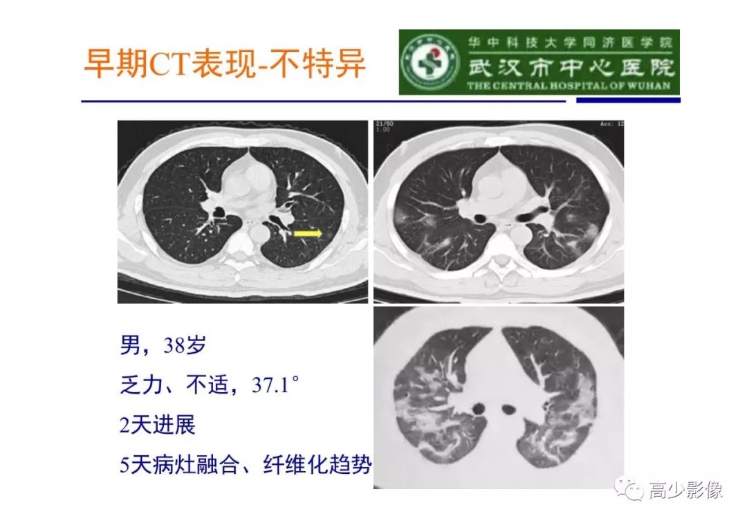 【PPT】新冠状病毒肺炎指南解读及四例影像学表现初步总结