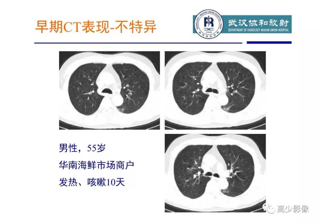 【PPT】新冠状病毒肺炎指南解读及四例影像学表现初步总结