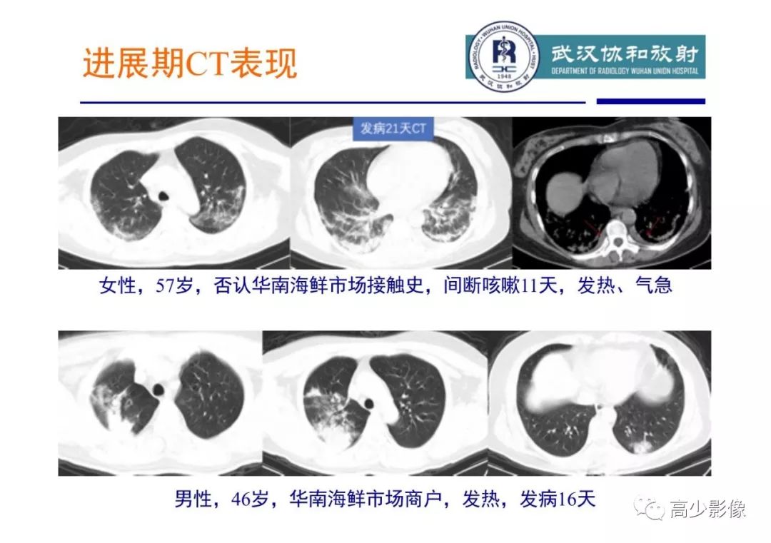 【PPT】新冠状病毒肺炎指南解读及四例影像学表现初步总结