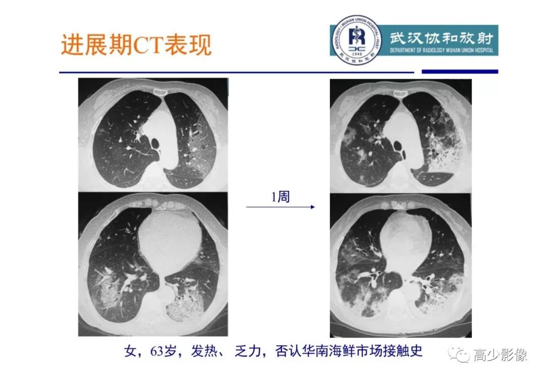 【PPT】新冠状病毒肺炎指南解读及四例影像学表现初步总结