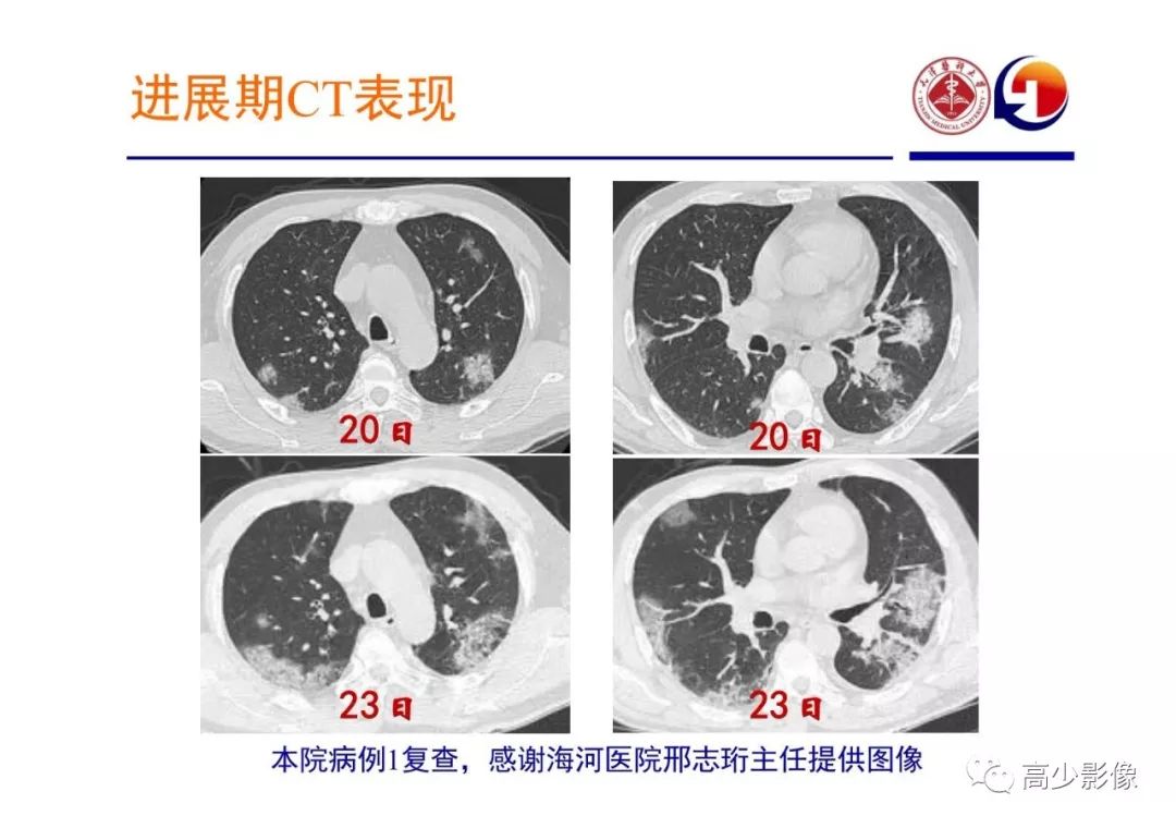 【PPT】新冠状病毒肺炎指南解读及四例影像学表现初步总结