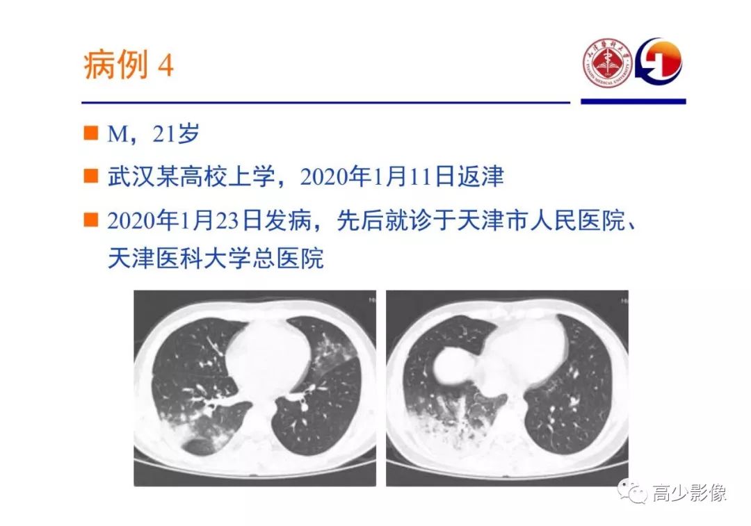 【PPT】新冠状病毒肺炎指南解读及四例影像学表现初步总结
