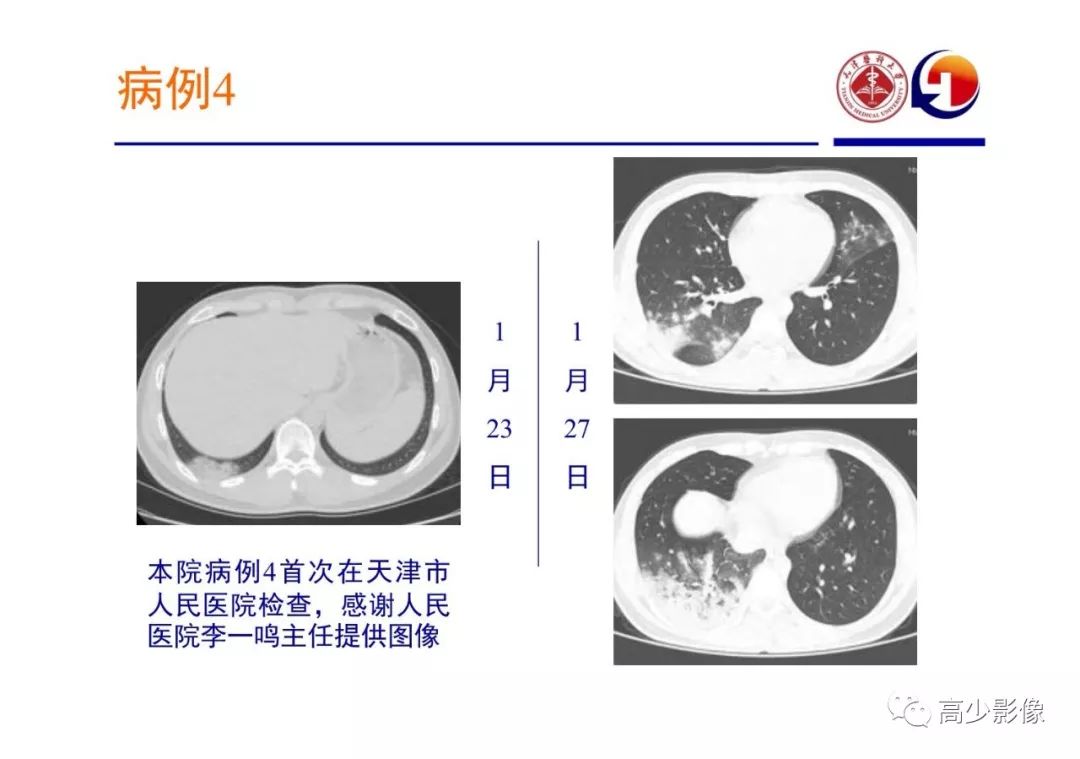 【PPT】新冠状病毒肺炎指南解读及四例影像学表现初步总结
