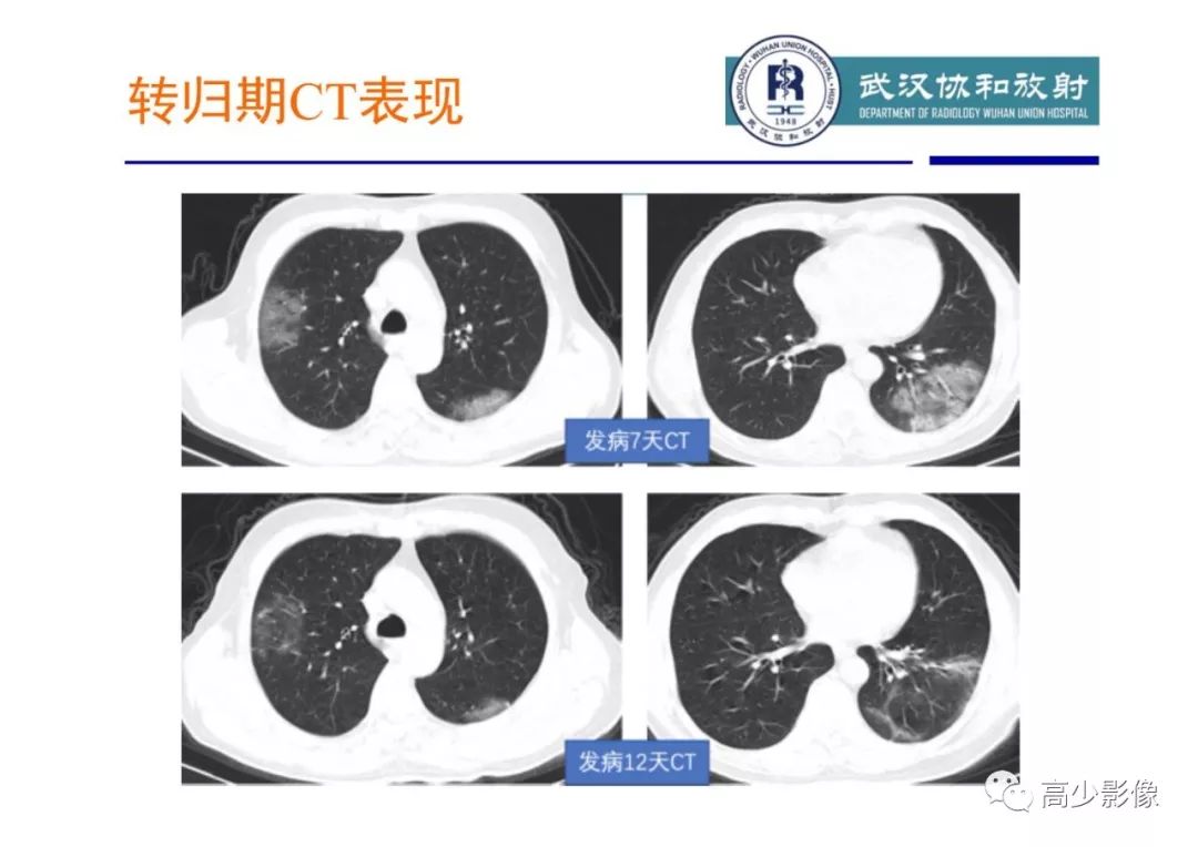 【PPT】新冠状病毒肺炎指南解读及四例影像学表现初步总结