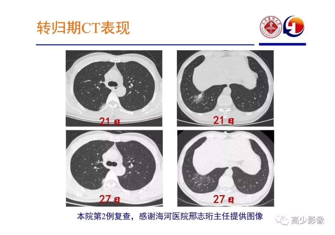 【PPT】新冠状病毒肺炎指南解读及四例影像学表现初步总结
