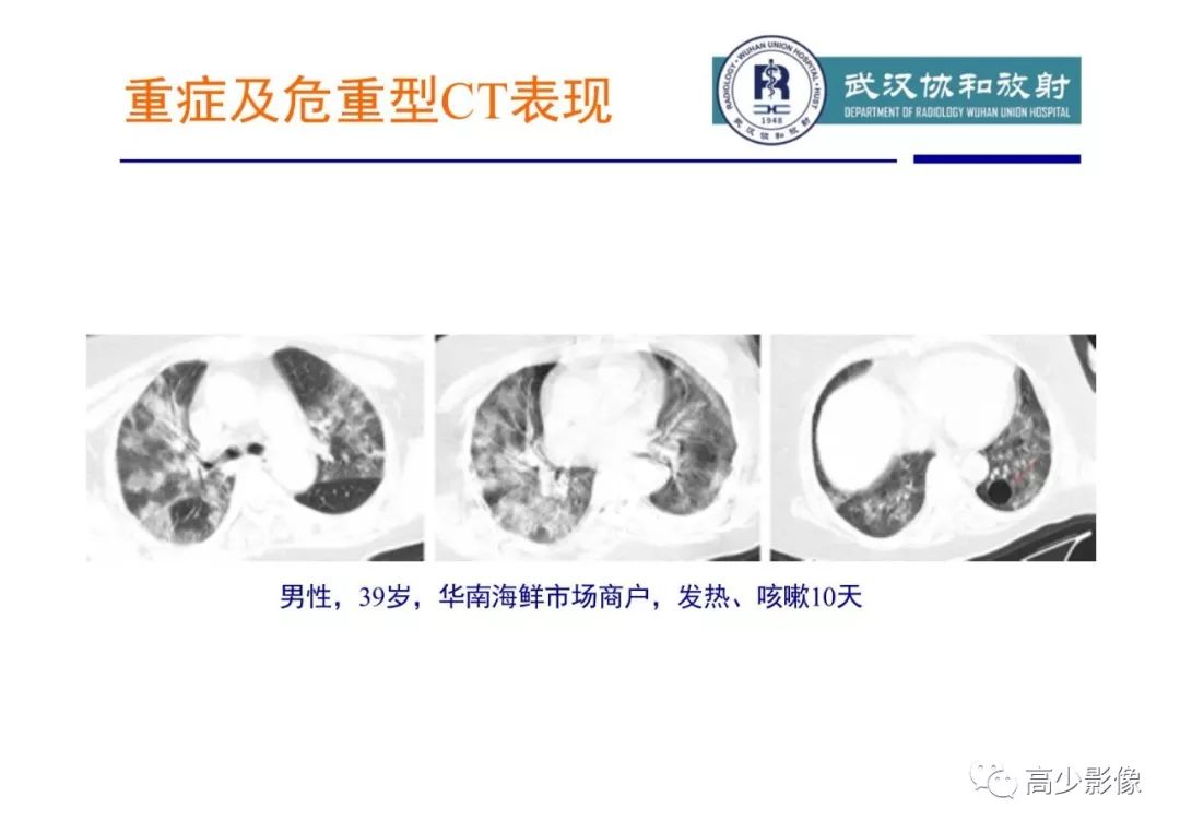 【PPT】新冠状病毒肺炎指南解读及四例影像学表现初步总结