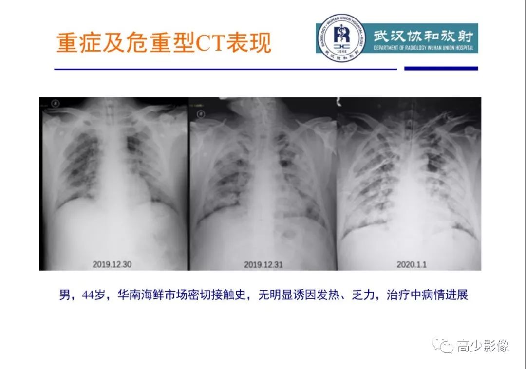 【PPT】新冠状病毒肺炎指南解读及四例影像学表现初步总结