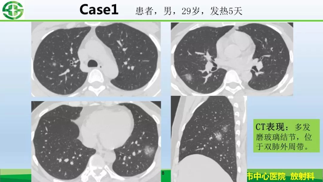 【PPT】新型冠状病毒（2019-nCoV）肺炎影像学表现病例分享