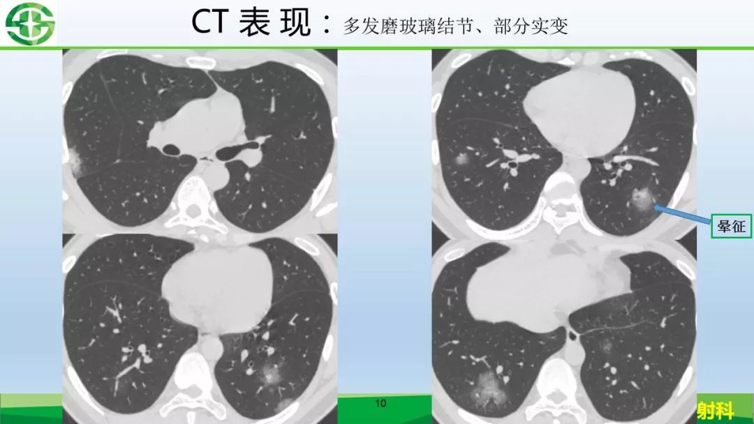【PPT】新型冠状病毒（2019-nCoV）肺炎影像学表现病例分享