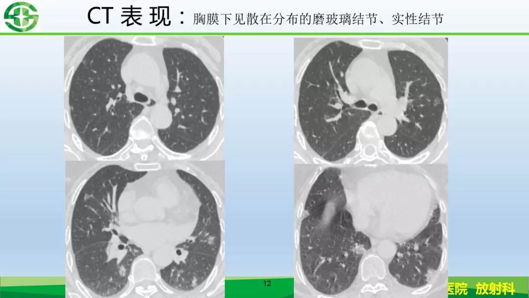 【PPT】新型冠状病毒（2019-nCoV）肺炎影像学表现病例分享