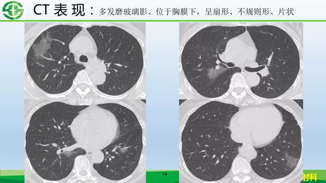 【PPT】新型冠状病毒（2019-nCoV）肺炎影像学表现病例分享