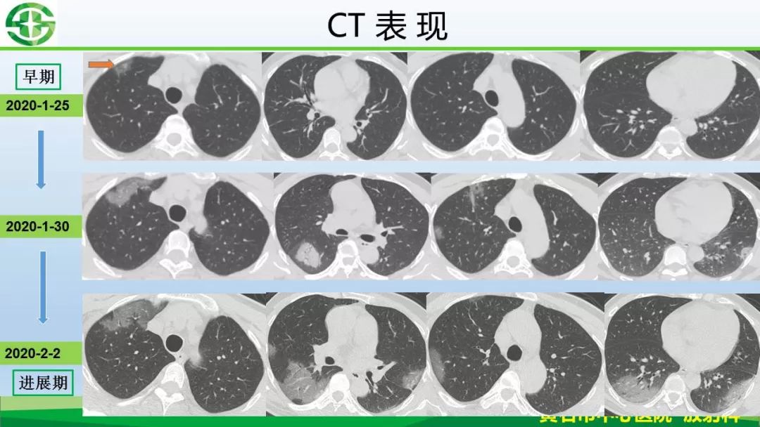 【PPT】新型冠状病毒（2019-nCoV）肺炎影像学表现病例分享