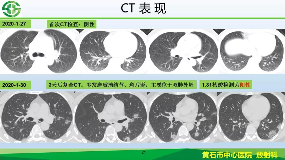 【PPT】新型冠状病毒（2019-nCoV）肺炎影像学表现病例分享