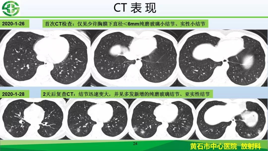 【PPT】新型冠状病毒（2019-nCoV）肺炎影像学表现病例分享