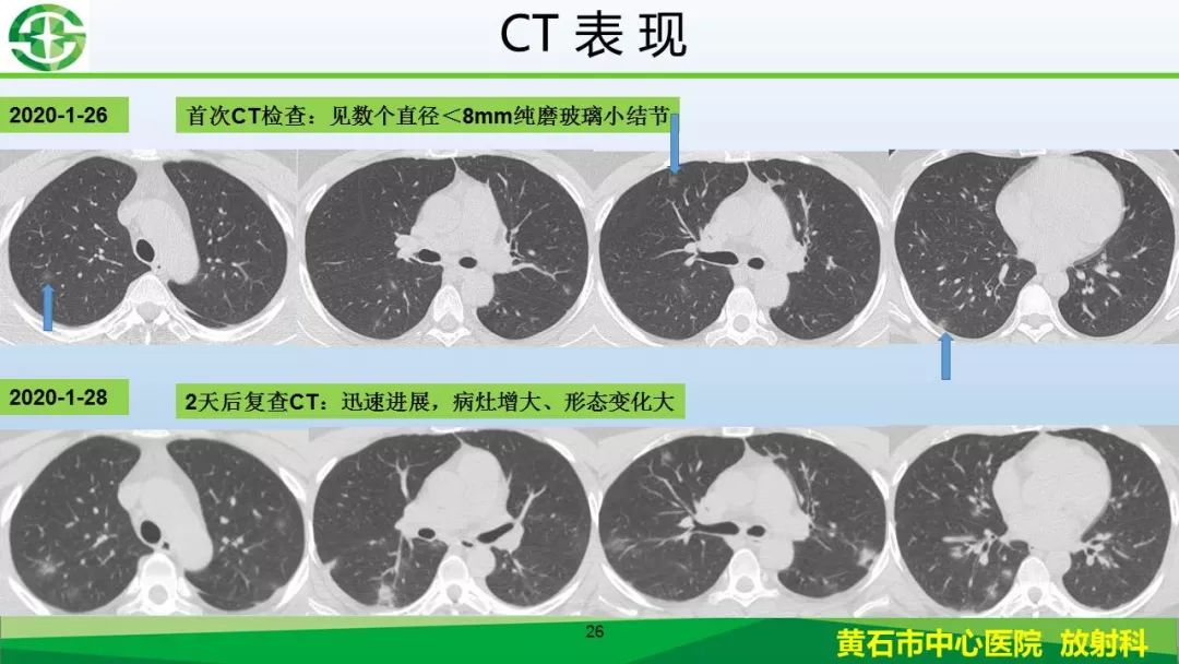【PPT】新型冠状病毒（2019-nCoV）肺炎影像学表现病例分享