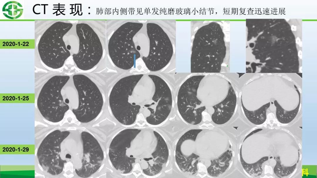 【PPT】新型冠状病毒（2019-nCoV）肺炎影像学表现病例分享