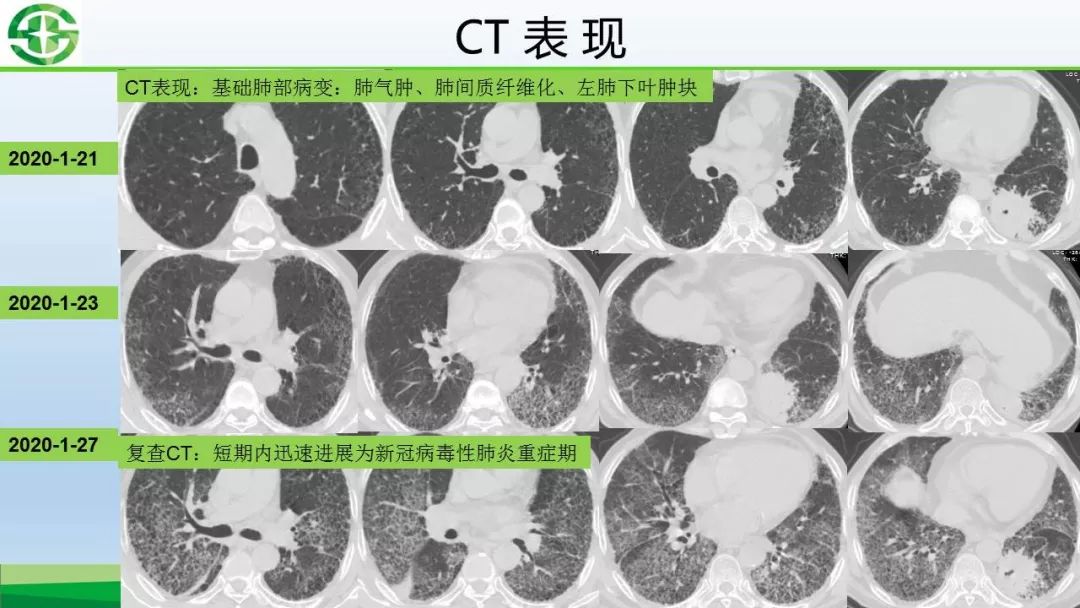 【PPT】新型冠状病毒（2019-nCoV）肺炎影像学表现病例分享