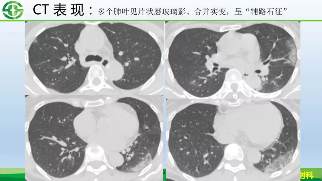 【PPT】新型冠状病毒（2019-nCoV）肺炎影像学表现病例分享