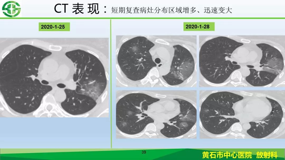 【PPT】新型冠状病毒（2019-nCoV）肺炎影像学表现病例分享