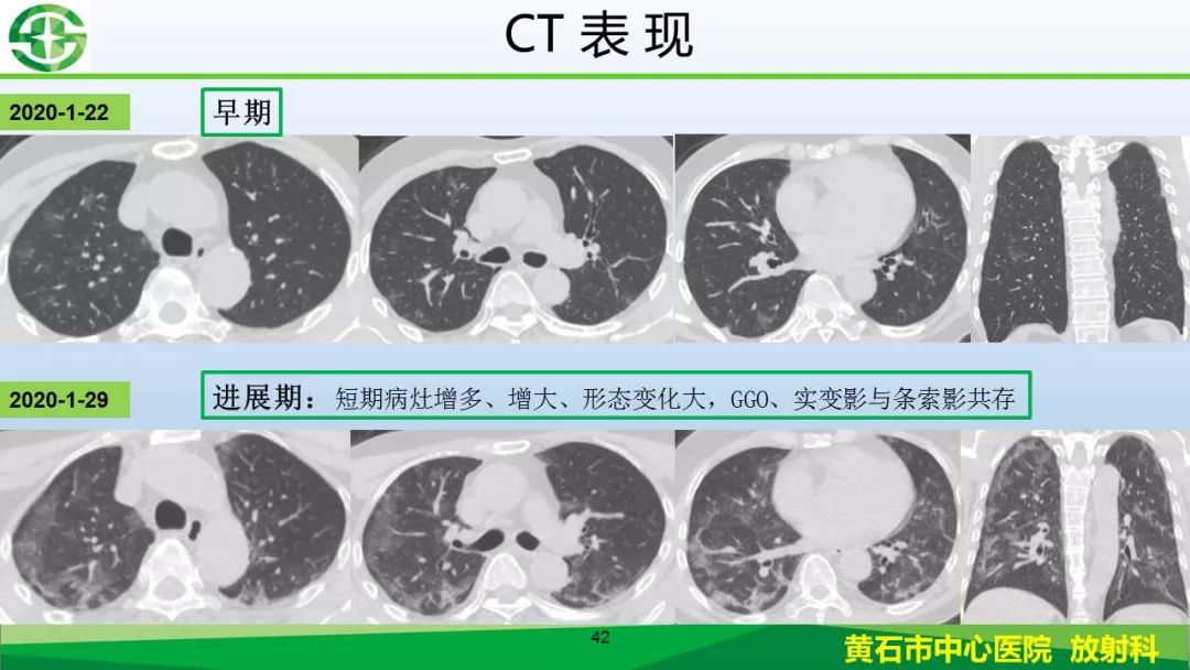 【PPT】新型冠状病毒（2019-nCoV）肺炎影像学表现病例分享