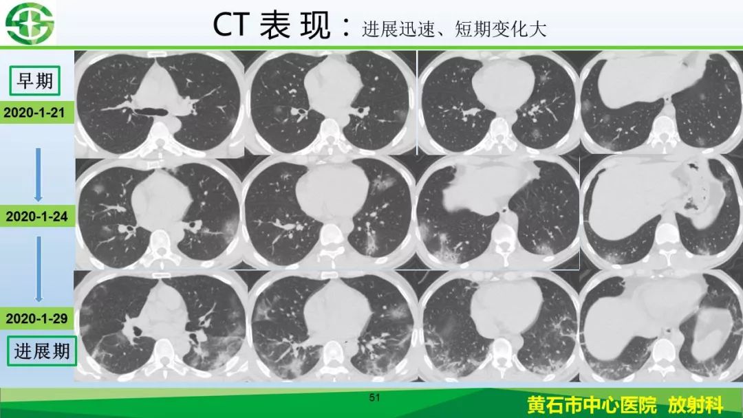 【PPT】新型冠状病毒（2019-nCoV）肺炎影像学表现病例分享