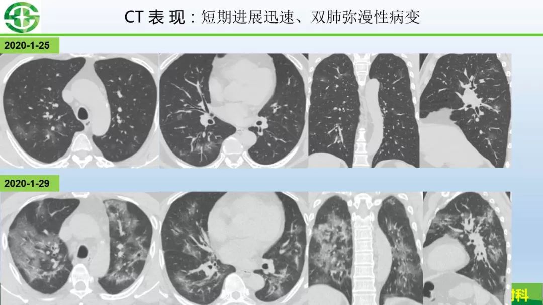【PPT】新型冠状病毒（2019-nCoV）肺炎影像学表现病例分享