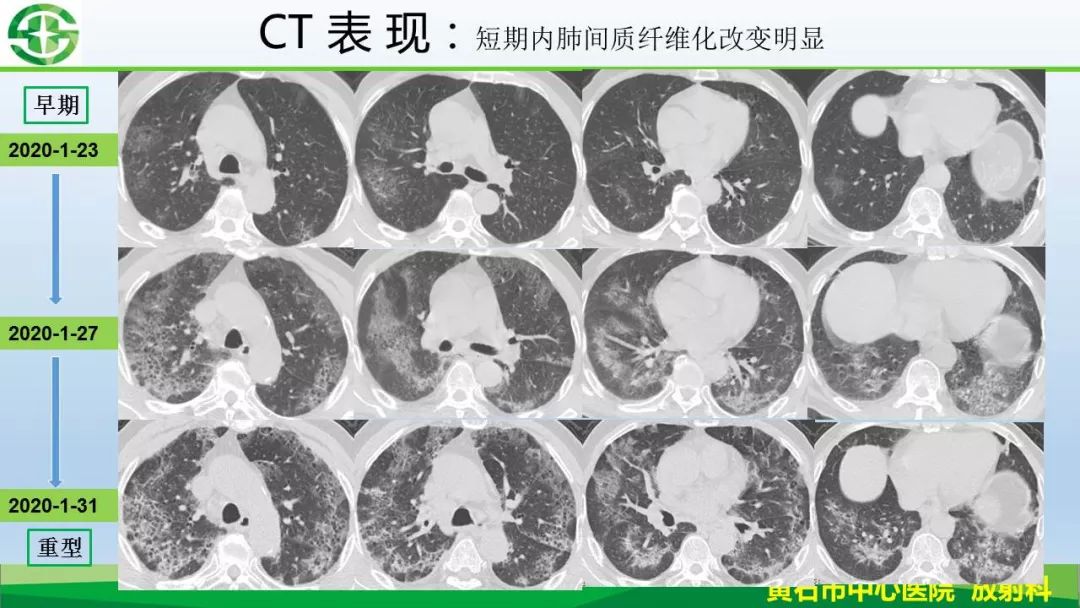 【PPT】新型冠状病毒（2019-nCoV）肺炎影像学表现病例分享